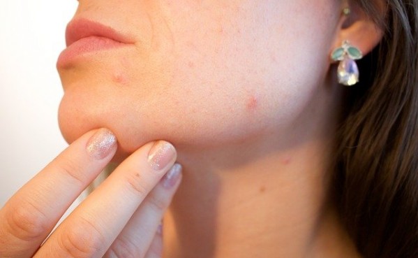 Seborrheic-Dermatitis-medicines